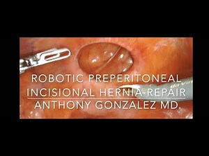 Robotic daVinci Xi Suprapubic Preperitoneal Incisional Hernia Repair