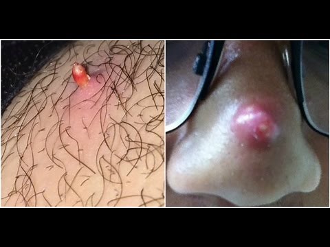 Imágenes terriblemente tentadoras para quienes adoran reventar granos