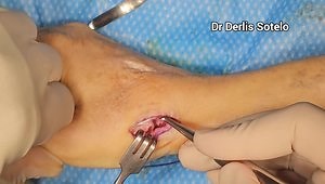 Revision Thumb CMC Suspension: Implant Removal and Mini TightRope Reconstruction