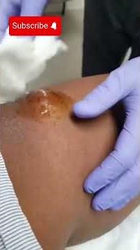 "Popping a Pus-Filled Pimple on the Leg – A Shocking Scene!" #pimplepopping #blackheadremoval