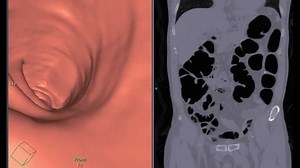 Ct Colonography Ct Scan Colon Comparison Stock Footage Video (100% Royalty-free) 1025833028 | Shutterstock