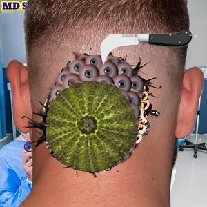 Back side neck infection remove relaxing sound 2d Asmr video 324 #amar_asmr909 #health Part 3 | Md Sakir 500