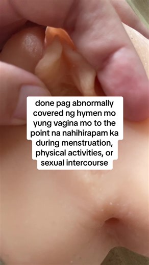 Understanding Hymenectomy: Removal Procedure and Reasons