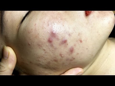How to Heal Blind Pimples Under the Skin | Cách Chữa Mụn Dưới Da - SacDepSpa#147