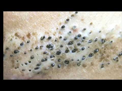 Extreme Blackheads - Oiliest Skin you'll ever see