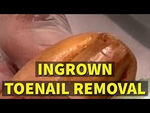 Ingrown Toenail Removal: Permanent Removal Procedure