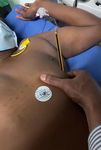 For medical students, residents. Apical impulse of a 35 yr old overweight male with past H/O syncope twice, presented with acute heart failure after onset of AF, reverted to sinus rhythm. Family H/O SCD. His pulse volume is normal. From the first impression , Double apex, (prominent S4 and heaving apical beat). Don’t comment on cardiomegaly as pt is turned to left side. Not easy to palpate apex beat in an overweight person like him. This much easily palpable prominent lift in such an obese guy m