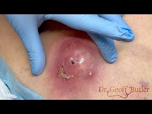 Drainage of a large infected epidermal cyst - Happy Easter!