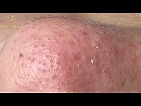 Loan Nguyen Acne Treatment 1431h