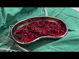 Relook clamshell thoracotomy | Blunt trauma chest