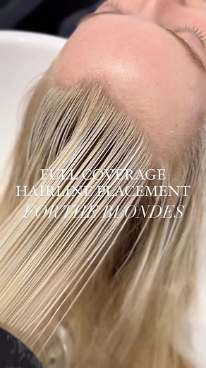67K views · 741 reactions | Full Coverage Hairline Placement ⬇️ By...