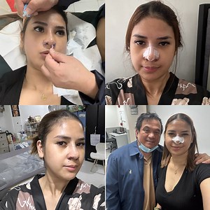 SUTURE AND CAST REMOVAL (Nose Job Reveal na?!) PART4 NA NG AKING RHINOPLASTY JOURNEY!! Doctor Marlon O. Lajo | Mommy Laiza