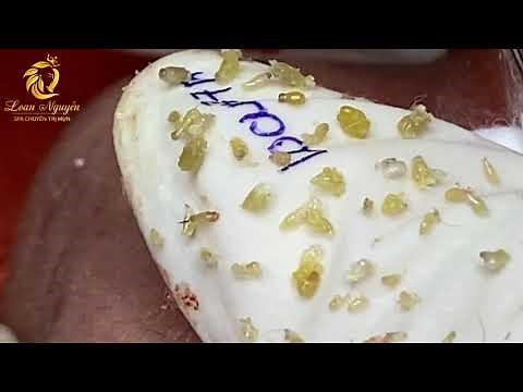 Blackheads removal and whiteheads extraction (375)