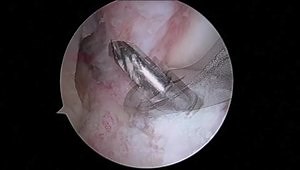All Inside ACL Reconstruction Technique