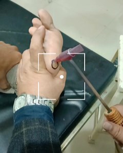 2.1M views · 2.6K reactions | Corn remove instant #reelsvideo #memes #ayurveda #reels #viral #medical | Vaidya Pawan Kaushik | Facebook