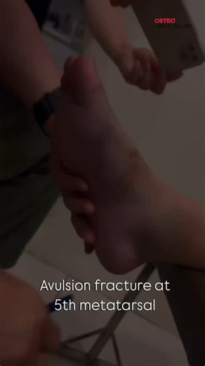 Avulsion fracture at the 5th metatarsal? It’s not just the bone — your ligaments often get pulled too. At our Tit Tar center, we realign your bones and treat the soft tissues together, so your recovery is complete and natural. 📍SS2 : 3, Jalan SS 2/55, SS 2, 47300 Petaling Jaya, Selangor 📍Bangsar Village II : 3F-3 Bangsar Village II, No 2, Jalan Telawi 1, Bangsar Baru, 59100 Kuala Lumpur 📍Kepong Baru : 18, Prsn Mergastua, Kepong Baru, 52100 KL 📍 Raub : No 30, Lorong Putra Raub 1, Pusat Pernia