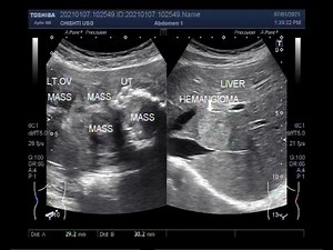 Multiple large Fibroids Uterus, Ovarian Mass and, Hepatic Hemangioma.