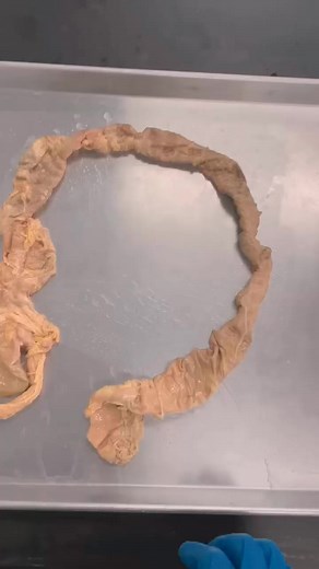 51K views · 725 reactions | A REAL Human Colon & Constipation#humen #body #fitness #fyp #healthy #gymlife #life #Doctor #reels #shorts | Human Anatomy | Facebook
