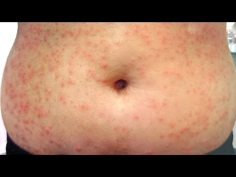 Miliaria (Heat Rash) - All 3 types - How to treat?
