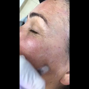 Black Diamond 💎 carthage byrsa #soinvisage #bbglow #microneedling #hydrafacial #antitache #antiride #coupdeclat #soyez_les_bienvenus 💕💕 | Black Diamond Beauty Center