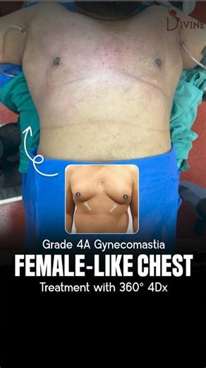 Severe Chest Enlargement? Grade 4A Gynecomastia Fixed with 360° 4Dx