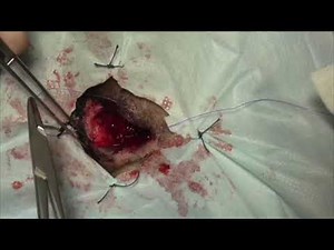 Eye removal surgery in a cat (transpalpebral enucleation)(left eye) (4x)