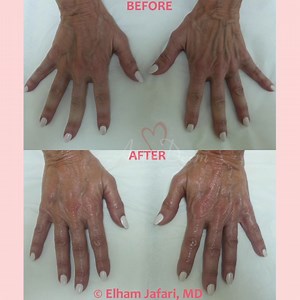  Hand rejuvenation with filler injection  ____  Procedure: Filler...