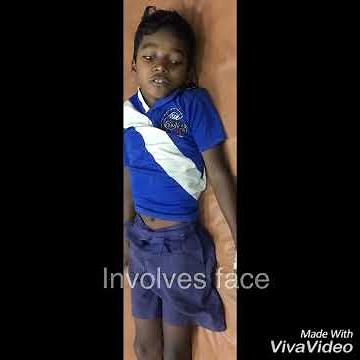 Sydenham chorea aka St.Vitus Dance