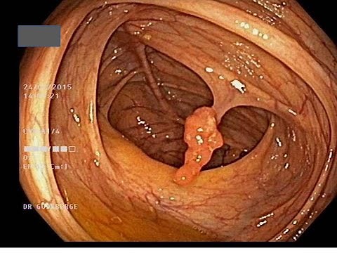 Coloscopie Se préparer