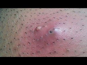 how to get rid of an ingrown hair in 2 days