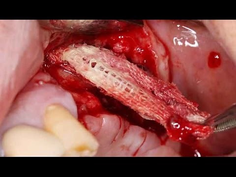 Intentional sinus perforation and pus drainage - Dr. Park Won-bae (Live)