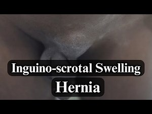 Examination of Inguino-scrotal Swelling (Hernia) | Standardized Clinical Examination Videos | KYAMC
