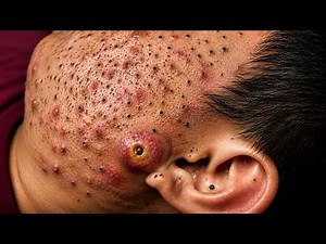 Satisfying Blackhead Removal & Pimple Popping for a Relaxing Mind #001