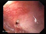 Colonic Interposition for Esophageal Substitution (1 of 11) • Video • MEDtube.net