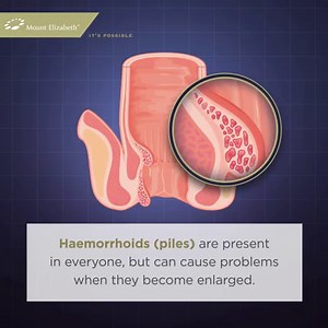 Haemorrhoids, commonly known as piles, are collections of tissue that contain enlarged blood vessels inside or around the rectum. Through piles removal surgery, large haemorrhoids can be removed, providing long term relief from pain and discomfort. Learn more about piles removal surgery: bit.ly/3b8KA6w. Mount Elizabeth Hospital’s Price Guarantee Procedures offers bill certainty for piles removal surgery. Patients get only one final bill for their procedure. Learn more here: bit.ly/2UirRPQ. To le