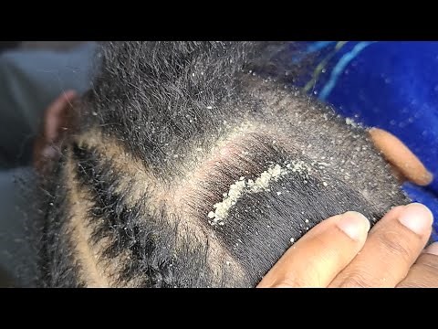 Dandruff Scratching close up 1/2