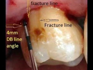 External root resorption #15