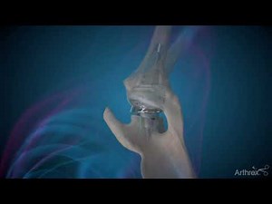 Personalized Reverse Total Shoulder Replacement With the Virtual Implant Positioning™ System