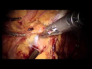 Prostate pelvic lymph node dissection with DaVinci Sealer