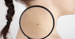 Bouton qui ne guérit pas : voici les signes qui doivent faire penser à un carcinome