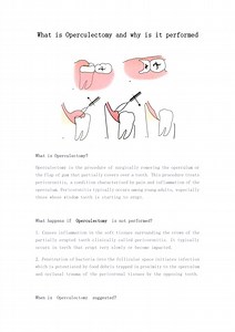 What is Operculectomy and why is it performed - SlideServe