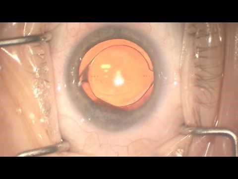 Piggyback IOL for Refractive Surprise (B&L Sofport LI61AO)
