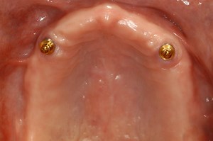 Dental Implants Duluth MN | Affordable Tooth Implants | Missing Teeth