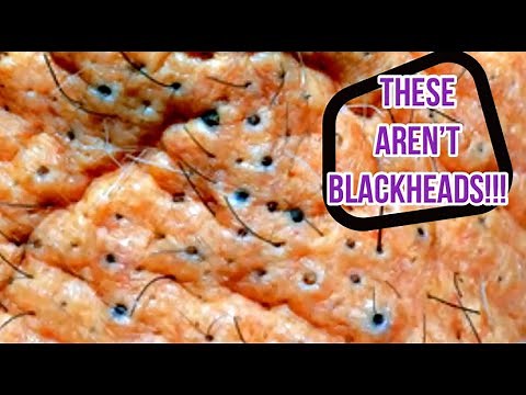 Giant Blackhead vs. Solar Comedones | Are They Clogged Pore Acne Or Sun Damage?