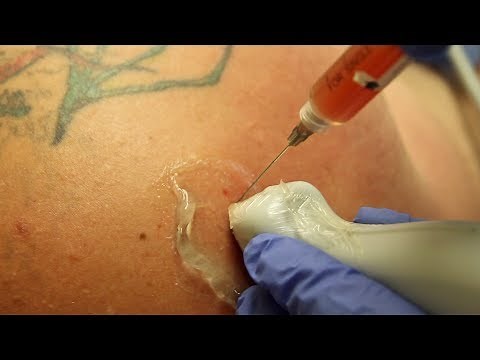 PRP INJECTION SHOULDER