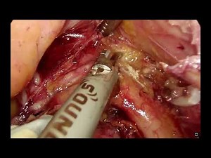 Laparoscopic posterior pelvic exenteration and total vaginectomy for rectal squamous cell carcinoma