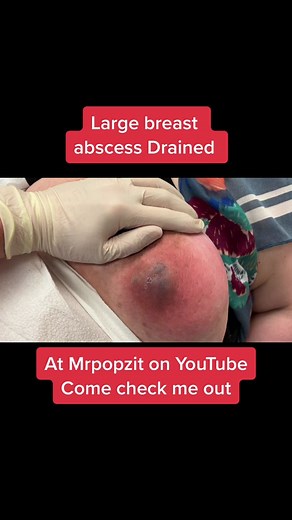 Giant breast abscess drained at MrPopZit on YouTube. Over 400 videos just like this. Come check me out 😉 #dermatology #physicianassistant #popaholic #dermatologypa #abscess #mrpopzit #incisionanddrainage #inflamedcyst