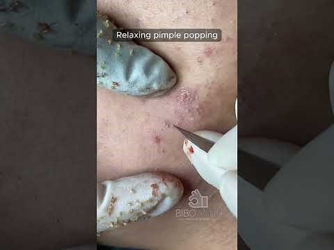 Popping Blackheads and Pimples