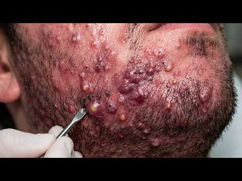 Satisfying Pimple Popping and Acne Treatment #011