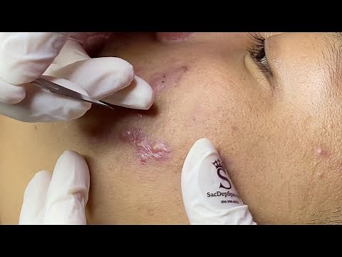 Inflamed Acne (Cystic Acne and Other Types) | Điều Trị Mụn Viêm - SacDepspa#247